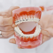 Orthodontic Braces
