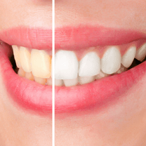 Teeth Whitening