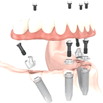 Dental Implants