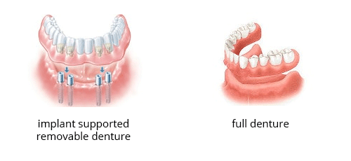 full-denture