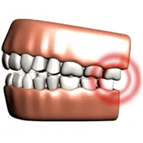 TMJ Treatment